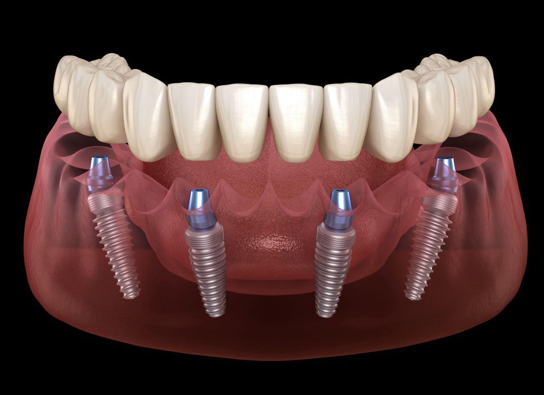 5 Reasons Why You Should Consider All-On-Four Dental Implants