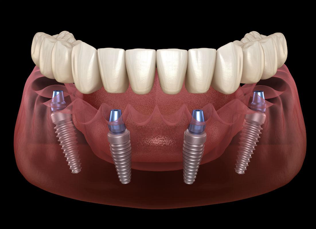 All-On-4 Implants Washington D.C.