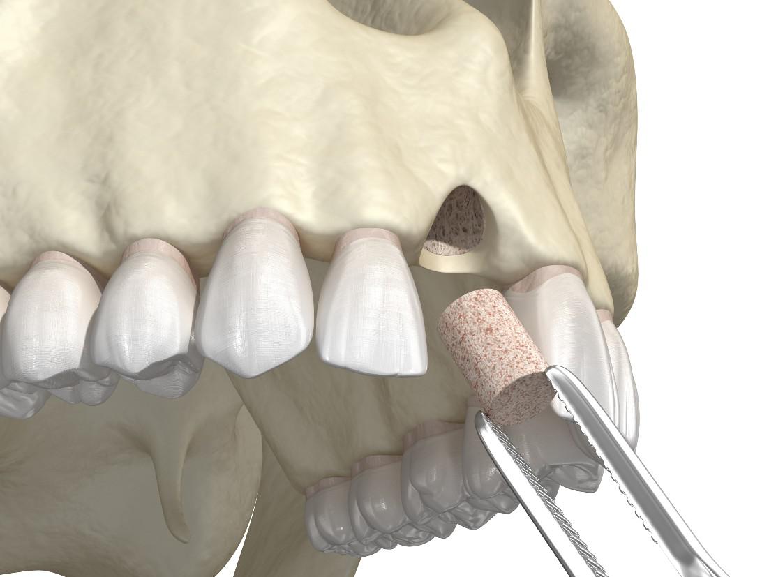 Bone Grafting 101 : Preparing For Successful Dental Implants