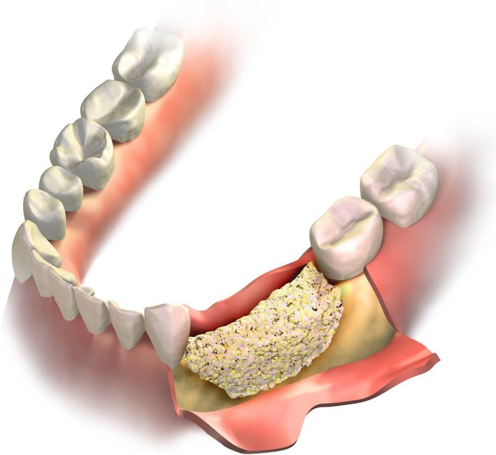 Bone Grafting Washington D.C.