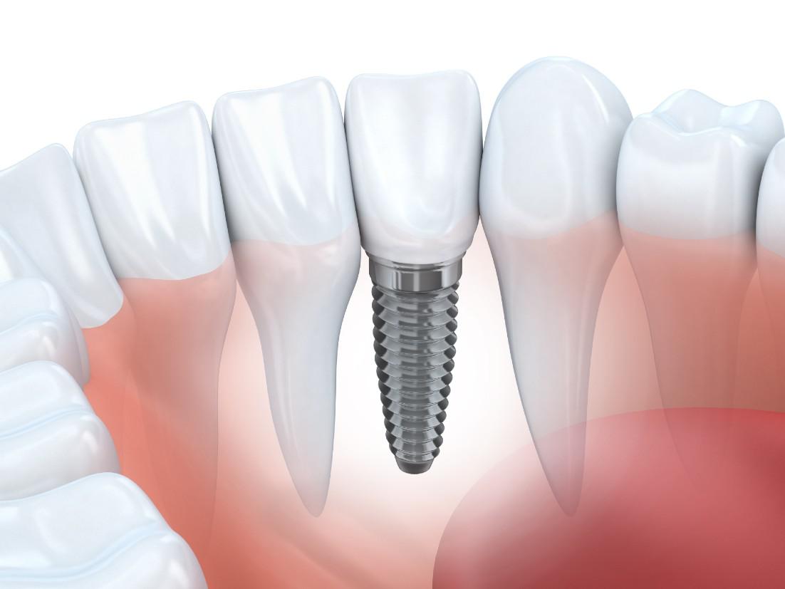 Dental Implants Washington D.C.