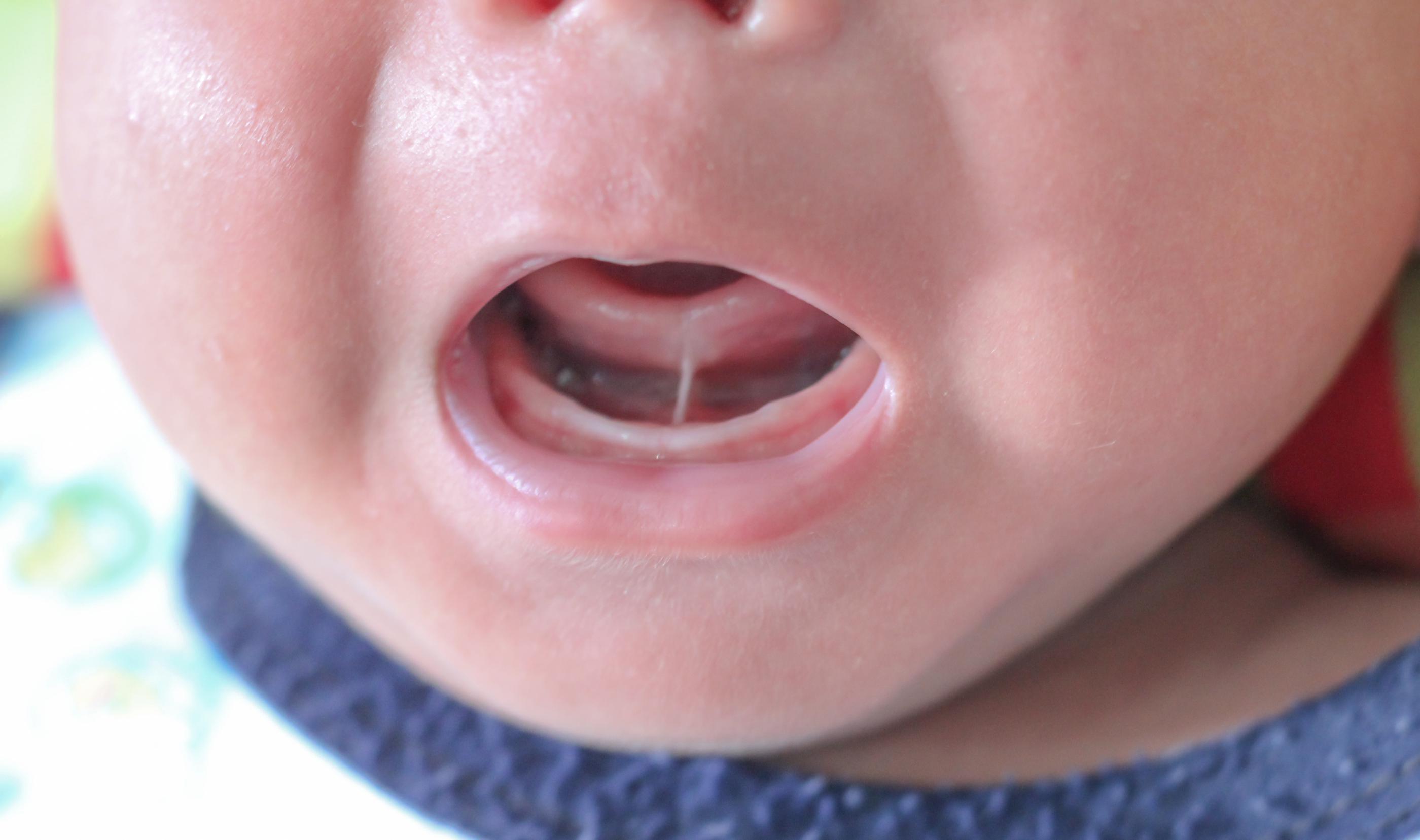 Frenectomy Washington D.C.