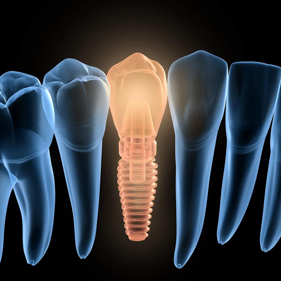 Dental Implants : A Permanent Soluton To Tooth Loss And Improved Oral Health