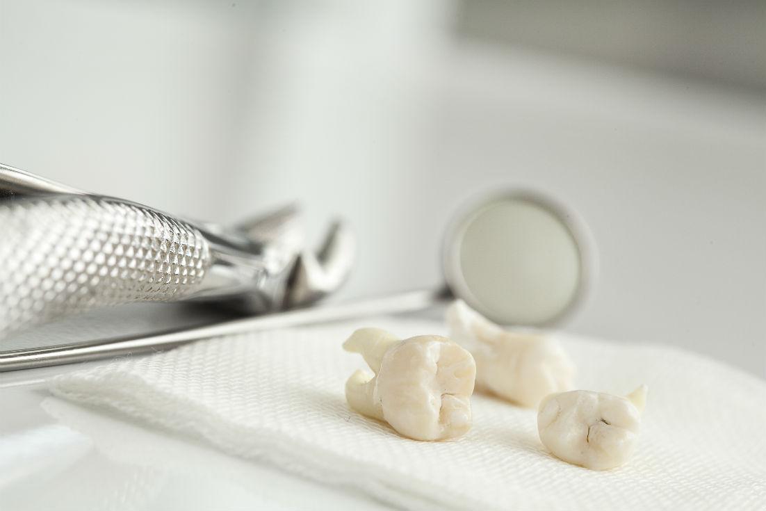 Preparing For Wisdom Teeth Removal : What You Need To Know