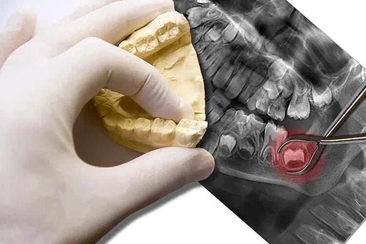 Wisdom Teeth Extractions Washington D.C.